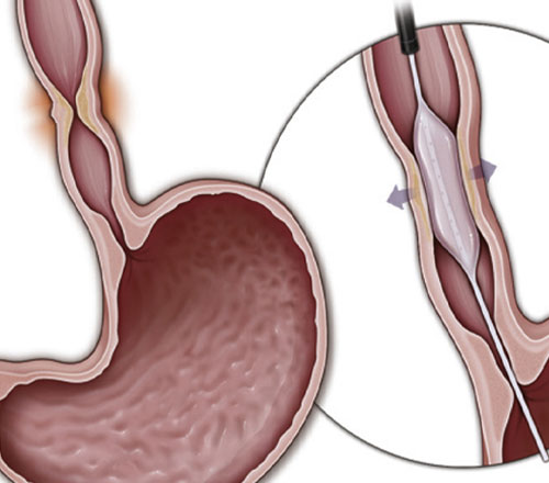 Dilation of Luminal Structure