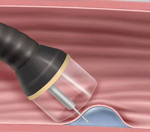 EMR(Endoscopic Mucosal Resection)