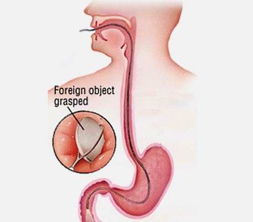 Foreign body removal