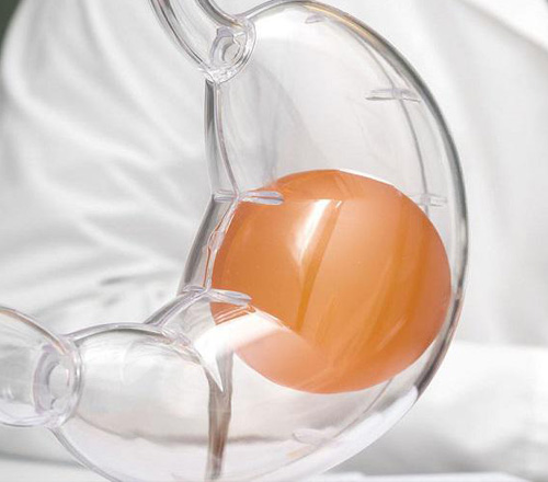 Intra Gastric Balloon Placement