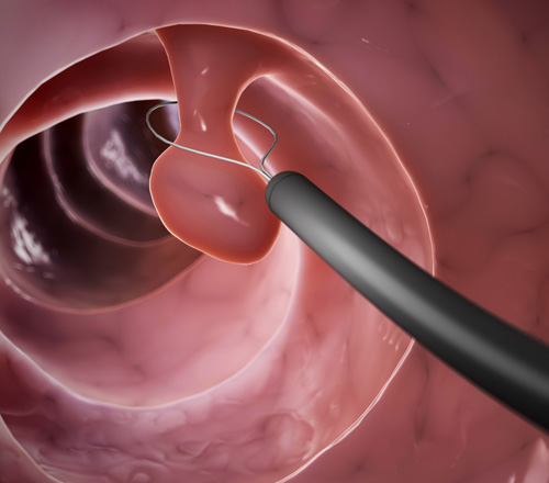 Polypectomy